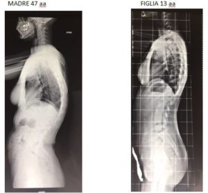 Radiografia cura Scoliosi a Bari